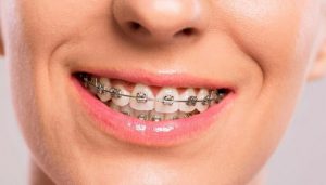 tips for first week in braces | first week of braces