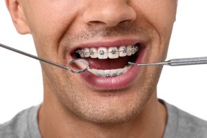 orthodontic treatment for adults