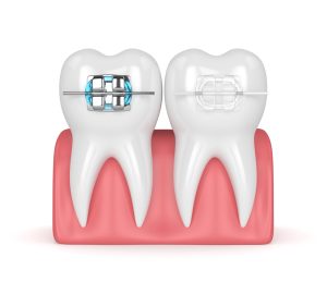 clear or metal braces